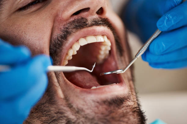 Best Emergency Wisdom Teeth Removal in George West, TX